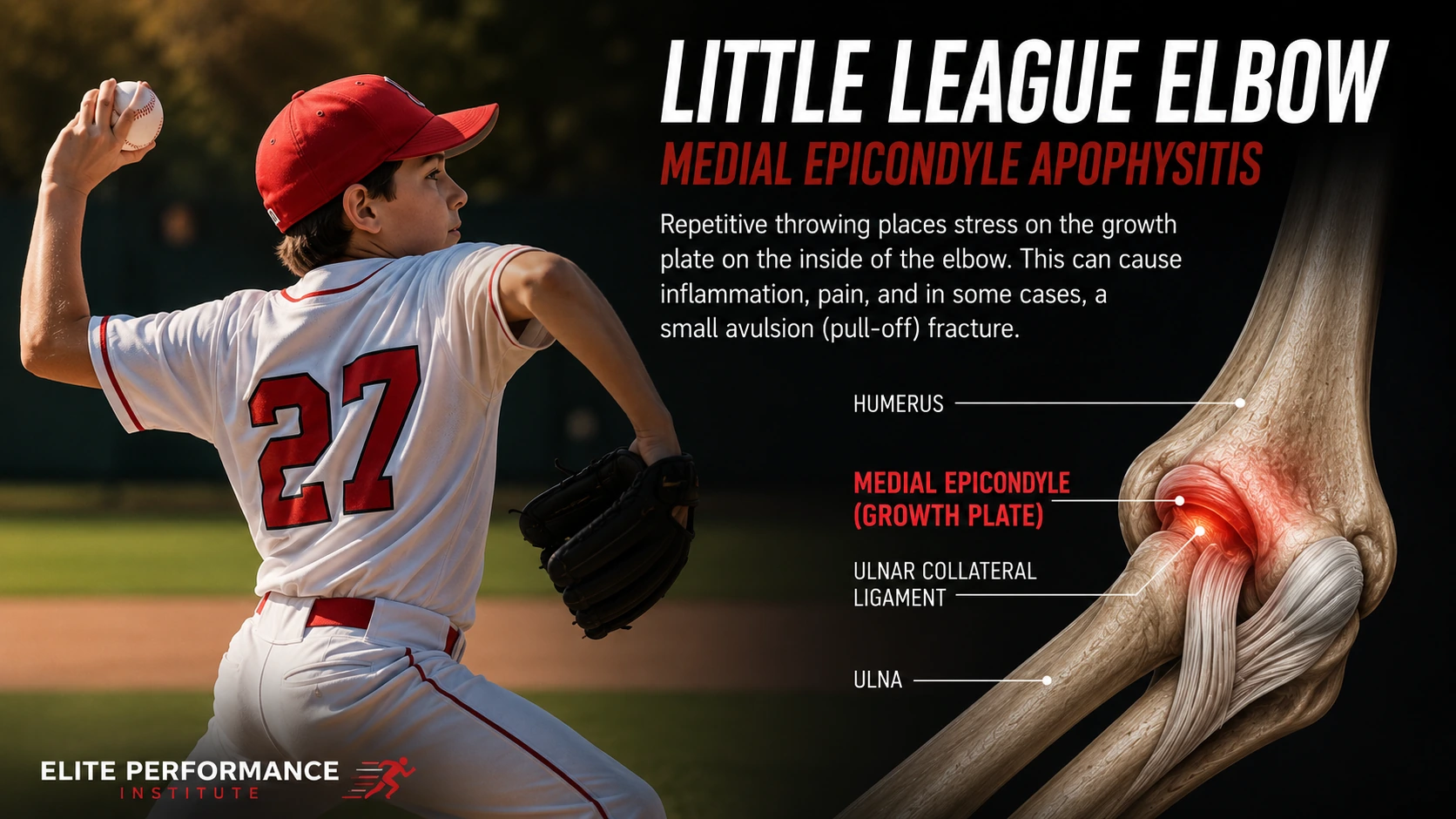 Little League Elbow Anatomy Little League elbow anatomy showing the medial epicondyle growth plate in a youth baseball pitcher